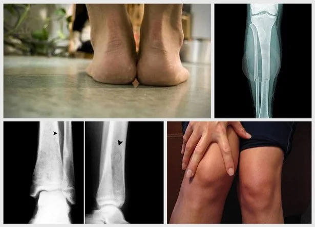 najčešće povrede u trčanju