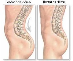 Slika 2. Izgled kičmenog stuba koji je usled mogućeg skraćenja m.iliopsoas-a doveo kičmeni stub u lordotičan izgled